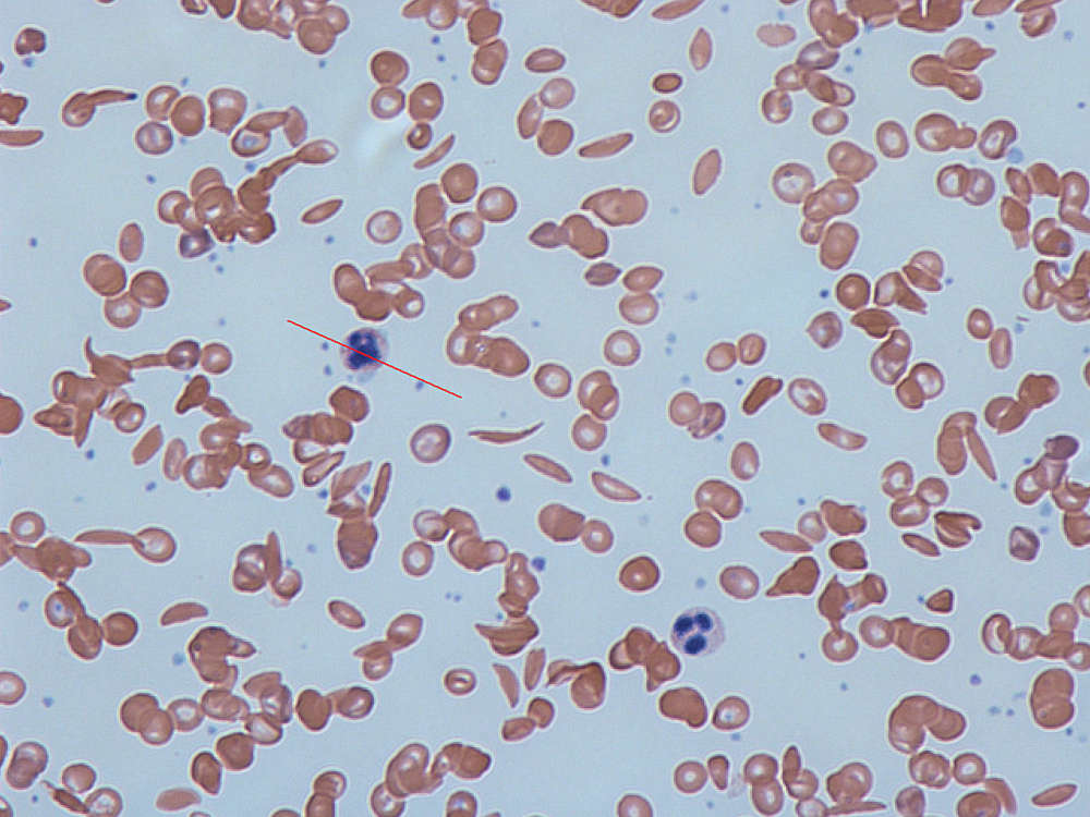 NEJM重磅！全球首例基因治疗镰状细胞病临床试验获得成功